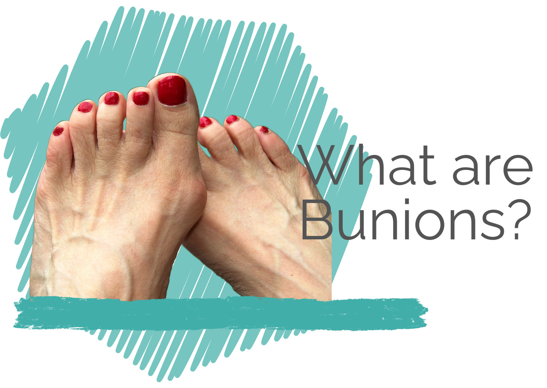 Bunion Pain & What to Do?